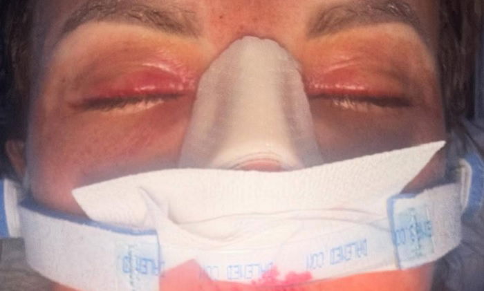 Harley Cameron Checks In With Graphic Photo, Video Update On Her Surgery For Nose Injury