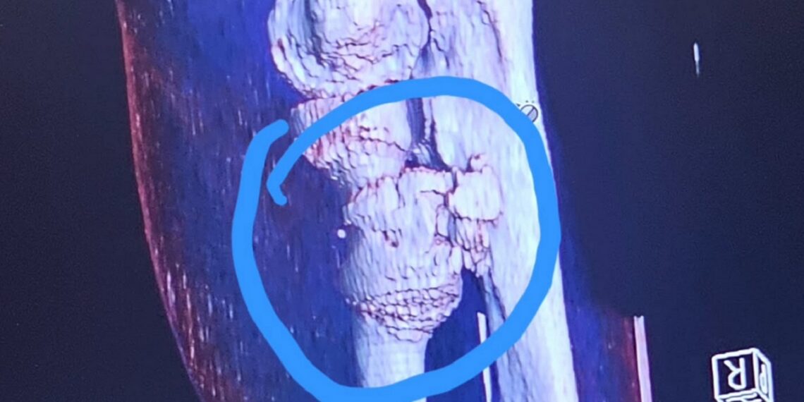 Anthony Henry of AEW and ROH team The WorkHorsemen shares X-Rays, injury update | Source: @anthonyrhenry on Instagram