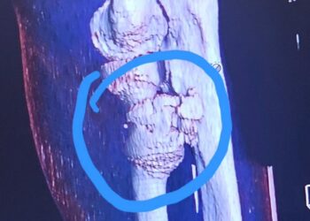 Anthony Henry of AEW and ROH team The WorkHorsemen shares X-Rays, injury update | Source: @anthonyrhenry on Instagram