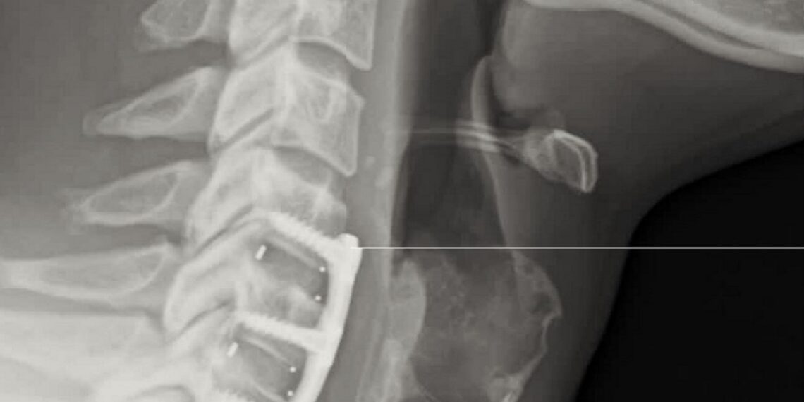 Will Ospreay neck injury X-ray | Source: Body Alignment Clinic