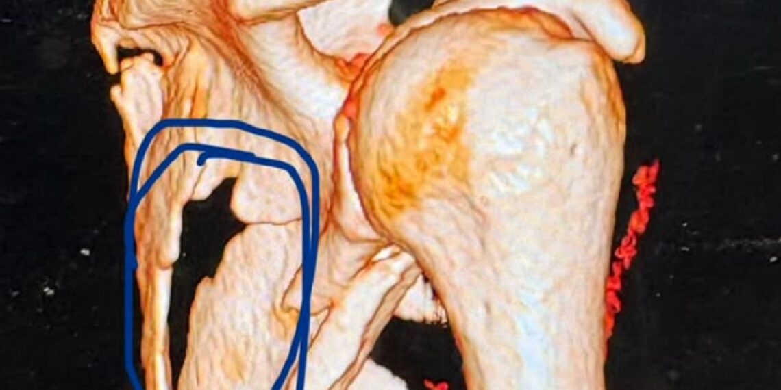 Brie Bella injury X-ray from SummerSlam 2026 | Image Source: Brie Bella Instagram