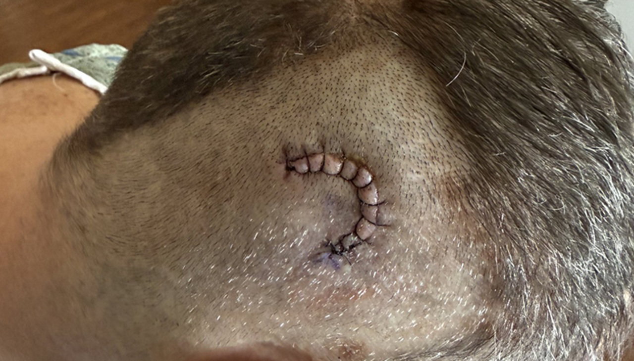 Jim Ross Shares Gruesome Photo After Brain Surgery